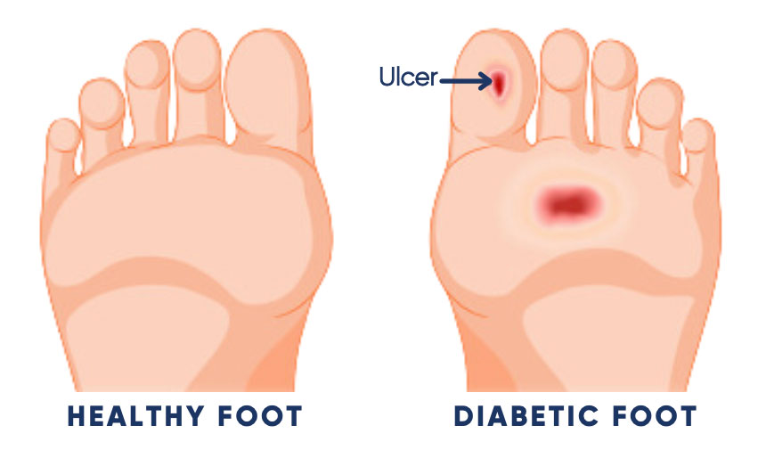 Illustration of a healthy foot compared to a diabetic foot with ulcers