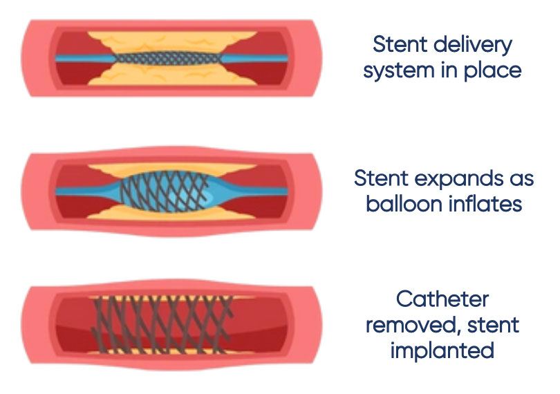 Angioplasty is used as a surgical revascularisation for diabetic and chronic wounds