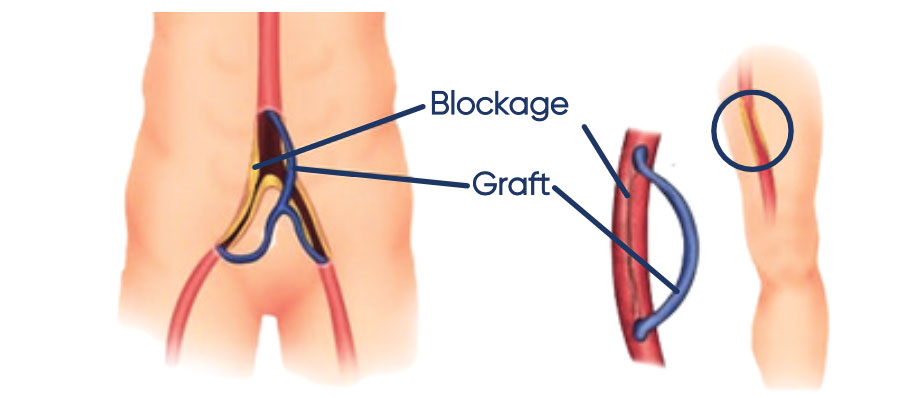 Stent placement often combined with angioplasty is used as a surgical revascularisation for diabetic and chronic wounds