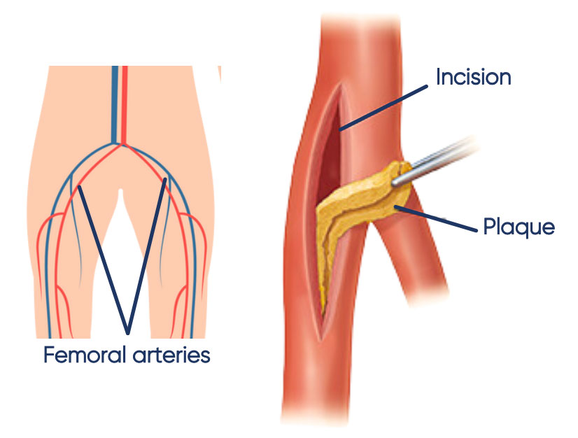 Stent placement often combined with angioplasty is used as a surgical revascularisation for diabetic and chronic wounds