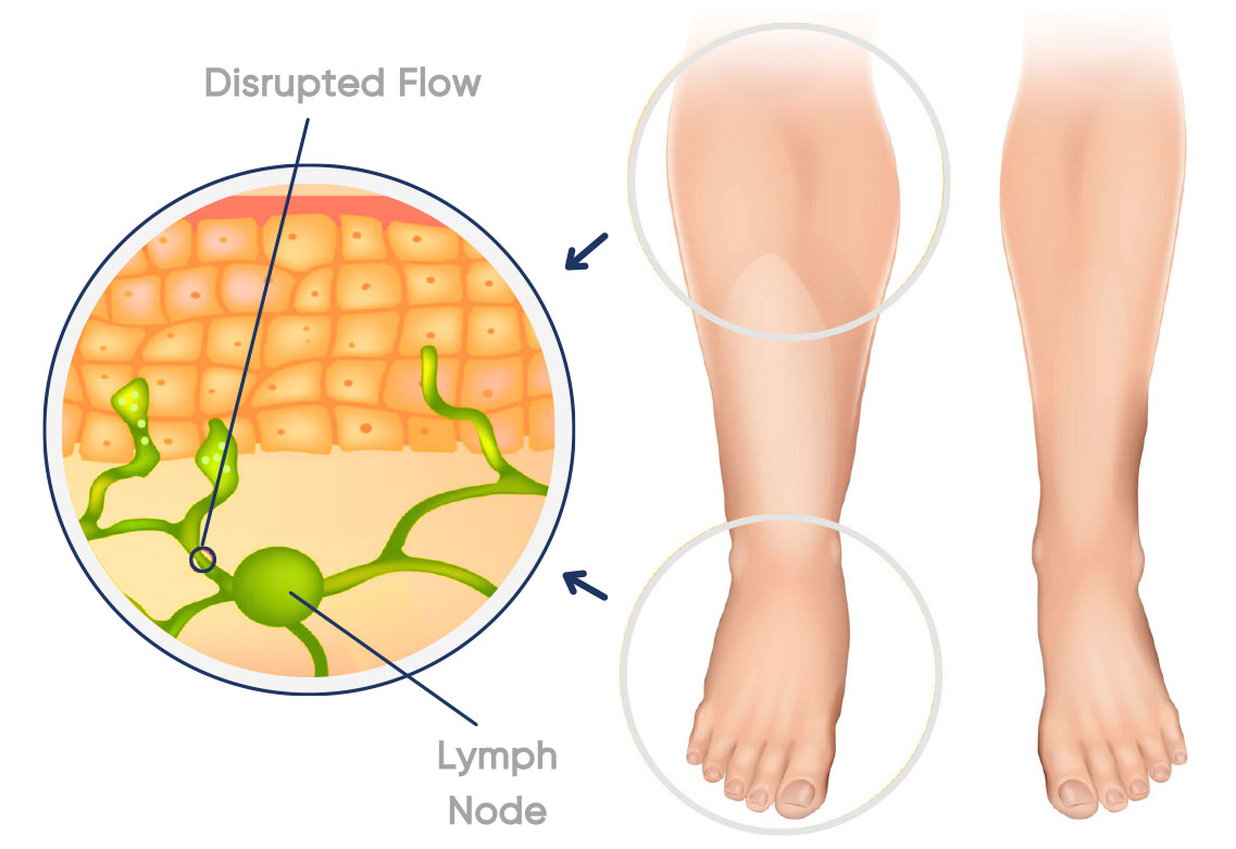 Diagram showing disrupted flow of lymphatic fluid