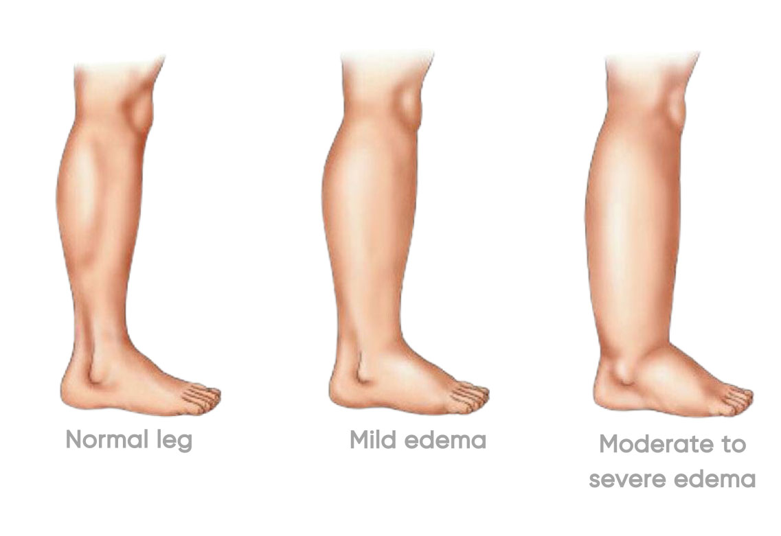 Diagram showing normal leg vs mild oedema vs moderate to severe oedema