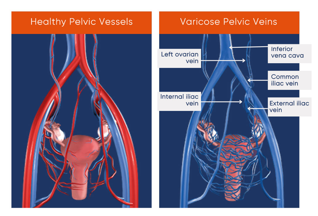 Healthy pelvic vessels compared to varicose pelvic veins
