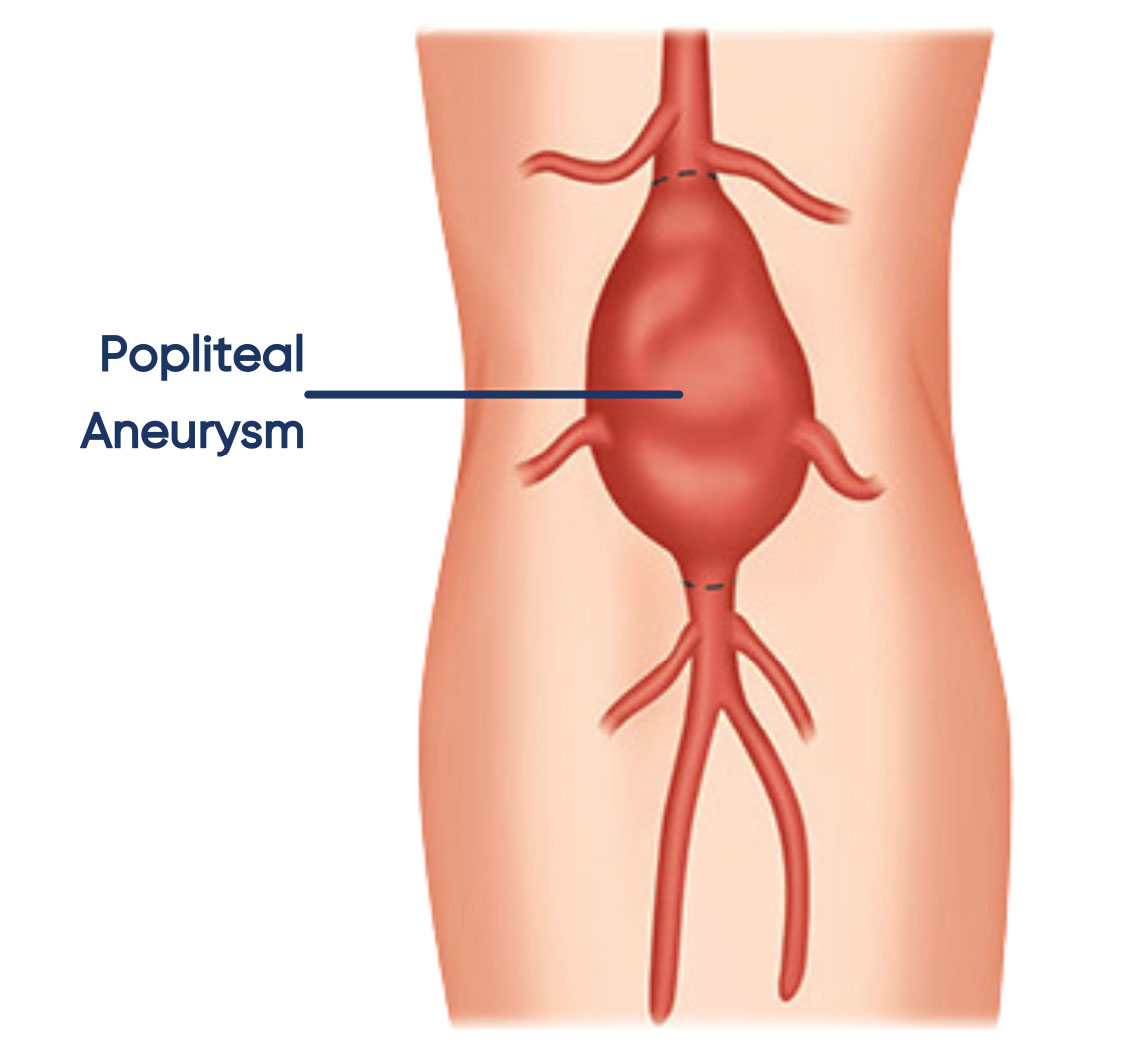 Popliteal aneurysm treatment Sydney