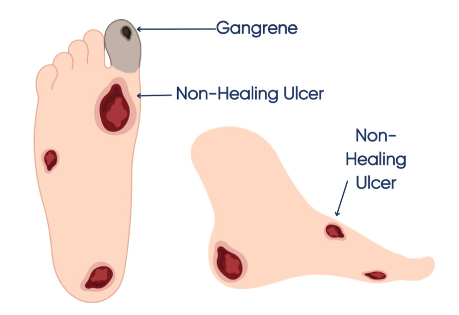 Ulcers and gangrene from peripheral arterial disease