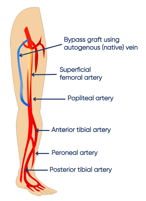 Open bypass surgery is used in the treatment of peripheral arterial disease.