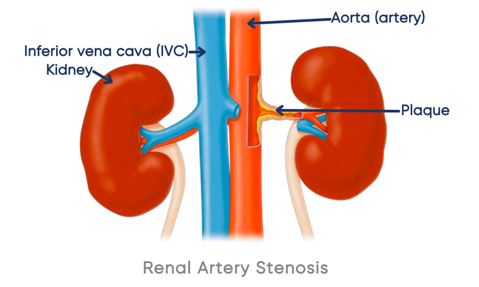 Renal artery insufficiency