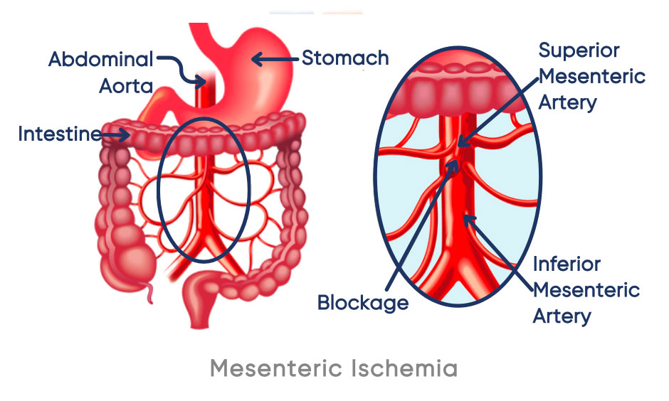 Mesenteric artery insufficiency