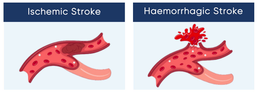 A stroke can be caused by a blood clot (ischemic stroke) or a ruptured blood vessel (haemorrhagic stroke). 