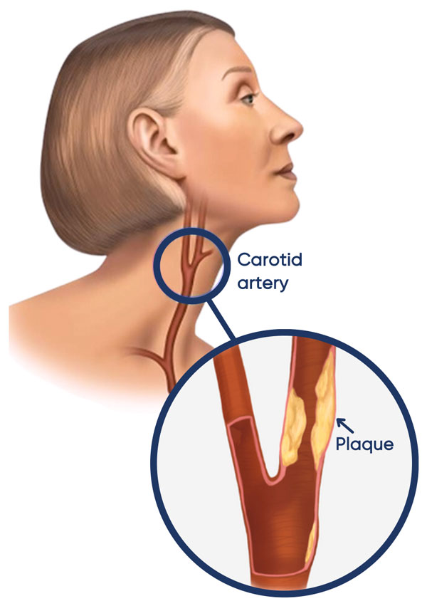 Carotid artery disease is a condition in which the carotid arteries, which supply blood to the brain, become narrowed or blocked.
