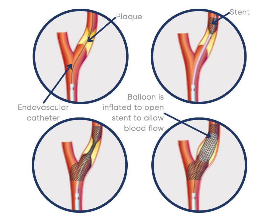 This minimally invasive procedure can be used to open a narrowed carotid artery and place a stent to keep it open.