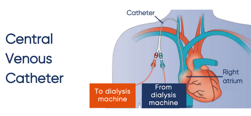 Central venous catheter insertion for dialysis