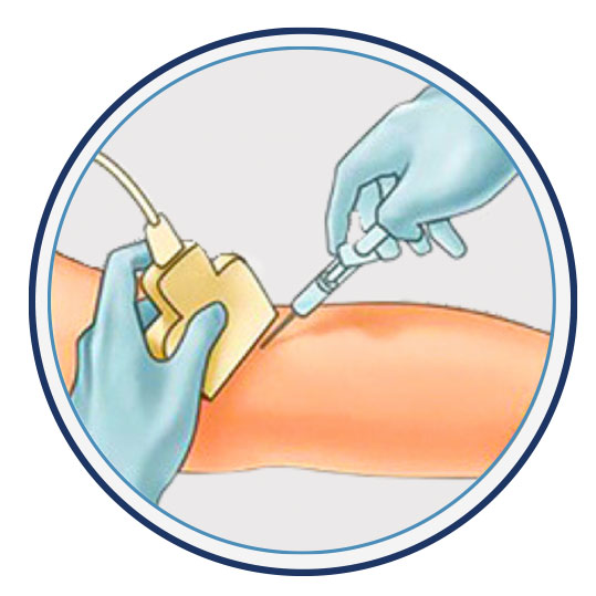 Ultrasound is used to locate the varicose vein, which helps to accurately inject the sclerosant agent.