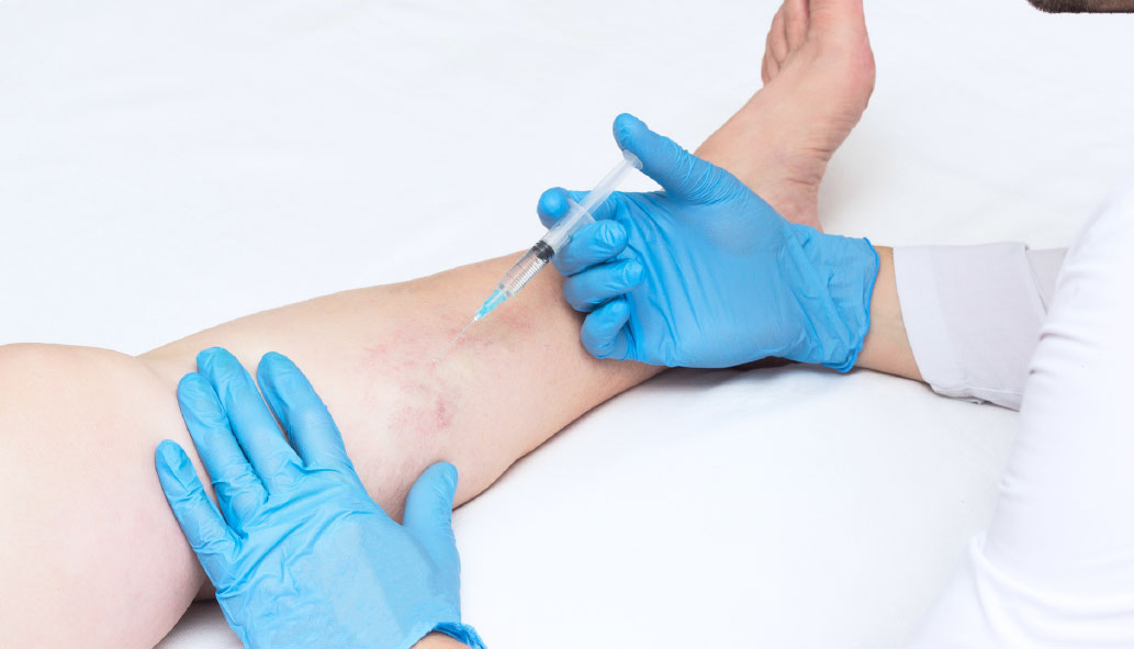 Photo of sclerosant being injected as treatment for varicose veins