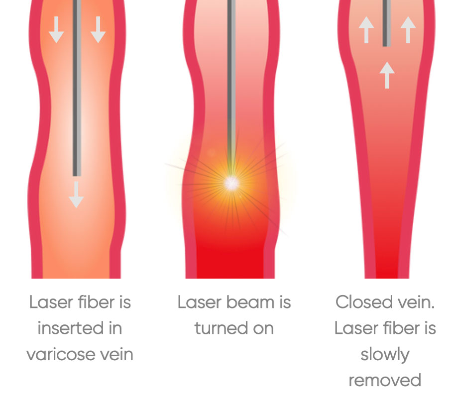 Endovenous laser treatment (EVLT) for Varicose Veins