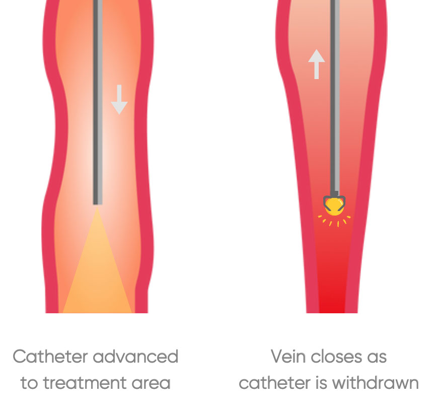 Radiofrequency ablation (RFA) for Varicose Veins