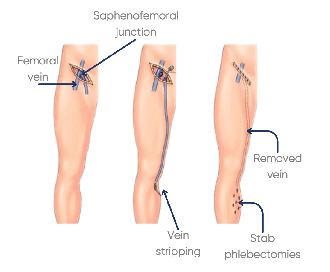Surgical ligation and stripping for Varicose Veins