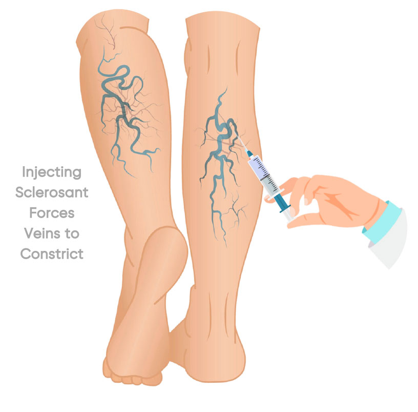 Sclerotherapy treatment for varicose veins