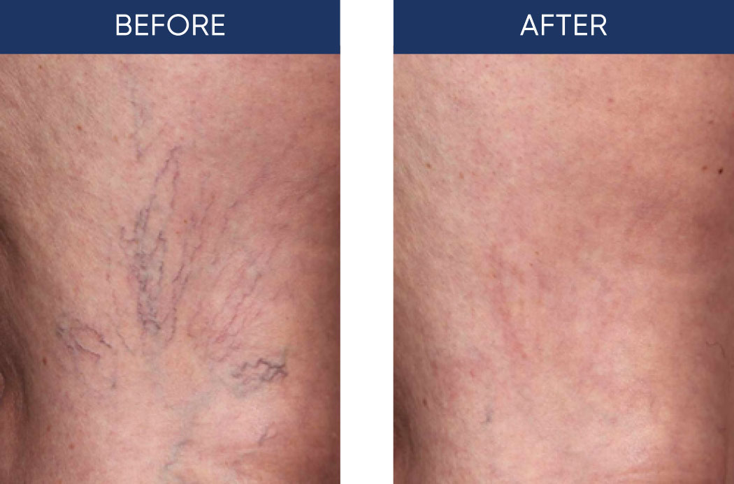 Cutera Laser Therapy for Varicose Veins